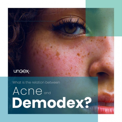âœ… What is the relation between acne and Demodex mites?