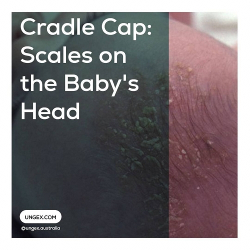 Cradle Cap: Scales on the Baby