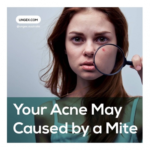 Your Acne May Caused by a Mite