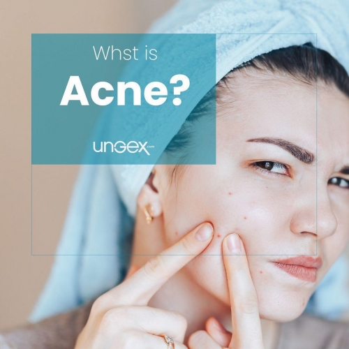 âœ…What is Acne?