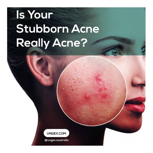 Is Your Stubborn Acne Really Acne?