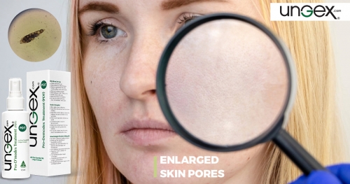 Enlarged Skin Pores