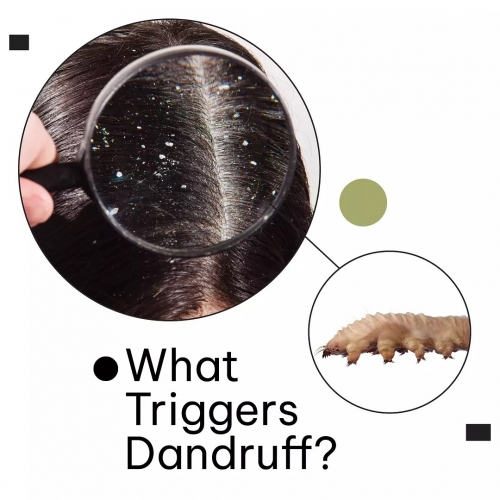 What Triggers Dandruff?