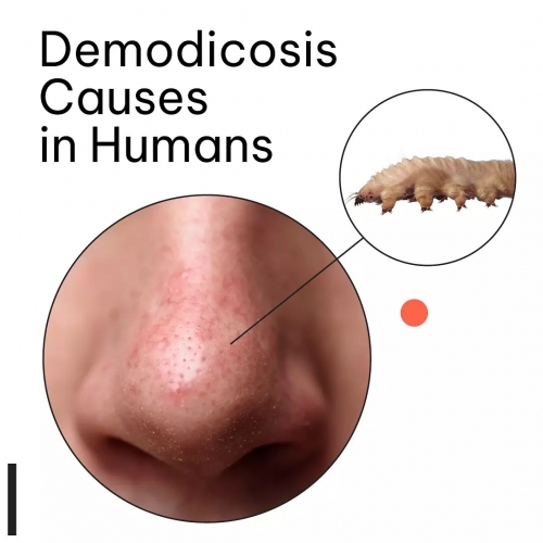Demodicosis Causes in Humans