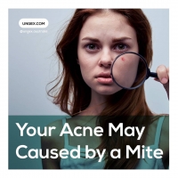 Your Acne May Caused by a Mite PickP
