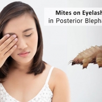 Demodex Mites on Eyelashes in Posterior Blepharitis