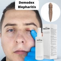 What is the recommended Demodex blepharitis treatment?