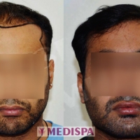 Hair Transplant in Delhi - Medispa Clinic
