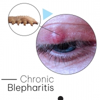 Chronic Blepharitis