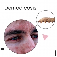 Demodicosis