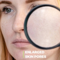 Enlarged Skin Pores PickP