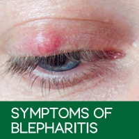Symptoms of Blepharitis PickP