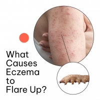 What Causes Eczema to Flare Up?