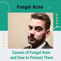 Causes of Fungal Acne and How to Prevent Them ðŸ¤”
